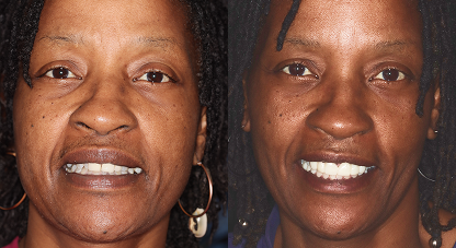 Audra before and after