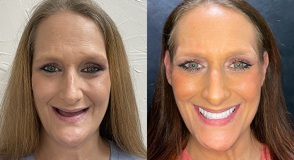 Leah before and after